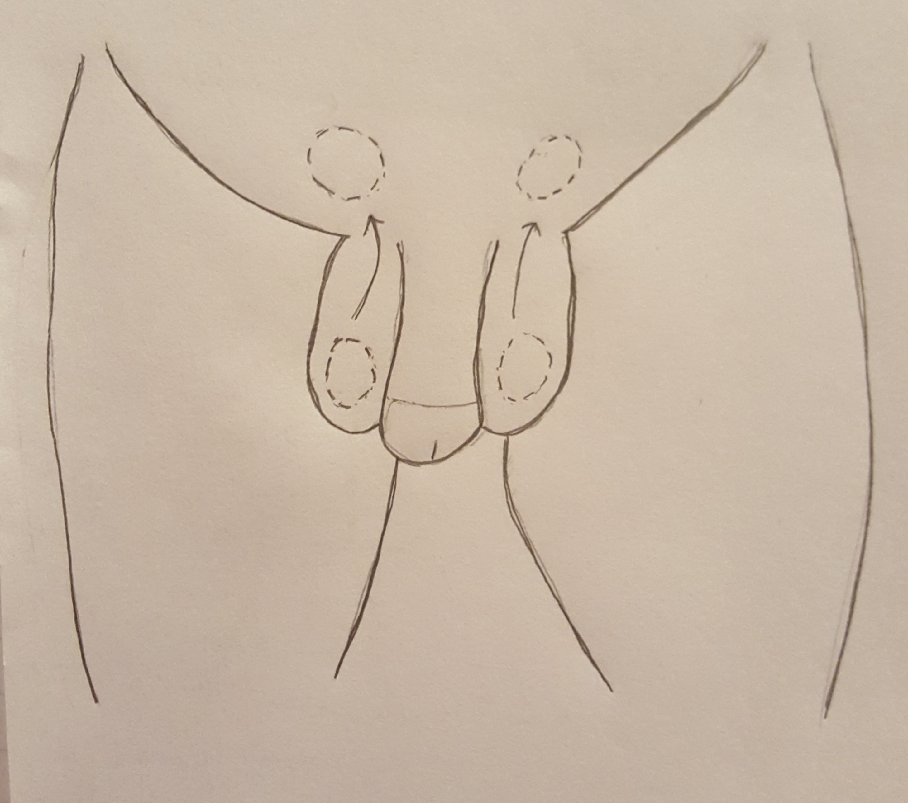 A drawing of penis and testicles. Arrows indicate to push each testicle upward into the abdomen to demonstrate the first step of tucking